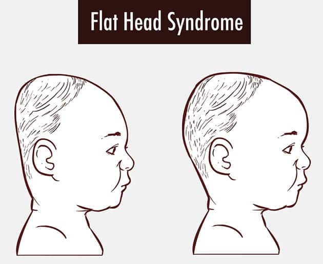 do car seats cause flat head